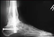 Ankle Arthrodesis with Structural Grafts Can Work for the Salvage of