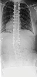 ADULT & ADOLESCENT DEFORMITY Scoliosis affects 2 to 3% of the population an estimated 6 to 9 million people in the United States alone.