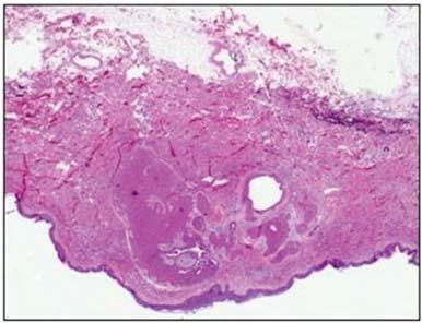 Barve N et al: Skin Adnexal Tumors (49/50) cases and only one case of malignant adnexal tumor (2%) was noted.