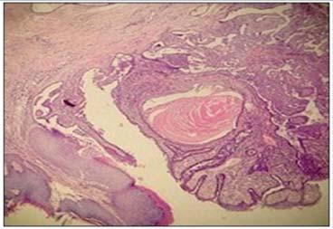 They are solitary or multiple. Figure 5: Cylindroma. (H&E stain., 20x.) Figure 3: Syringoma.