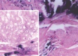 Figure 5: Pilomatricoma 5 inset showing shadow cells, (H & E, 400) Figure 6: Syringocystadenoma papilliferum - papillary projections into lumen, (H & E, 100) nuclei and the other with eosinophilic