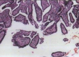 Recent studies show that pilomatricoma shows mutation of the β-catenin gene, which in turn may affect cell-to-cell adhesion.