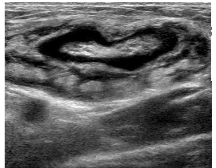 Kimura s Disease in the Lower Extremity d e C SC f g Fig. 1. d. Ultrasonography showed an enlarged lymph node with a preservation of the central echogenic fatty hilum, thickened cortex and perinodal infiltrations.
