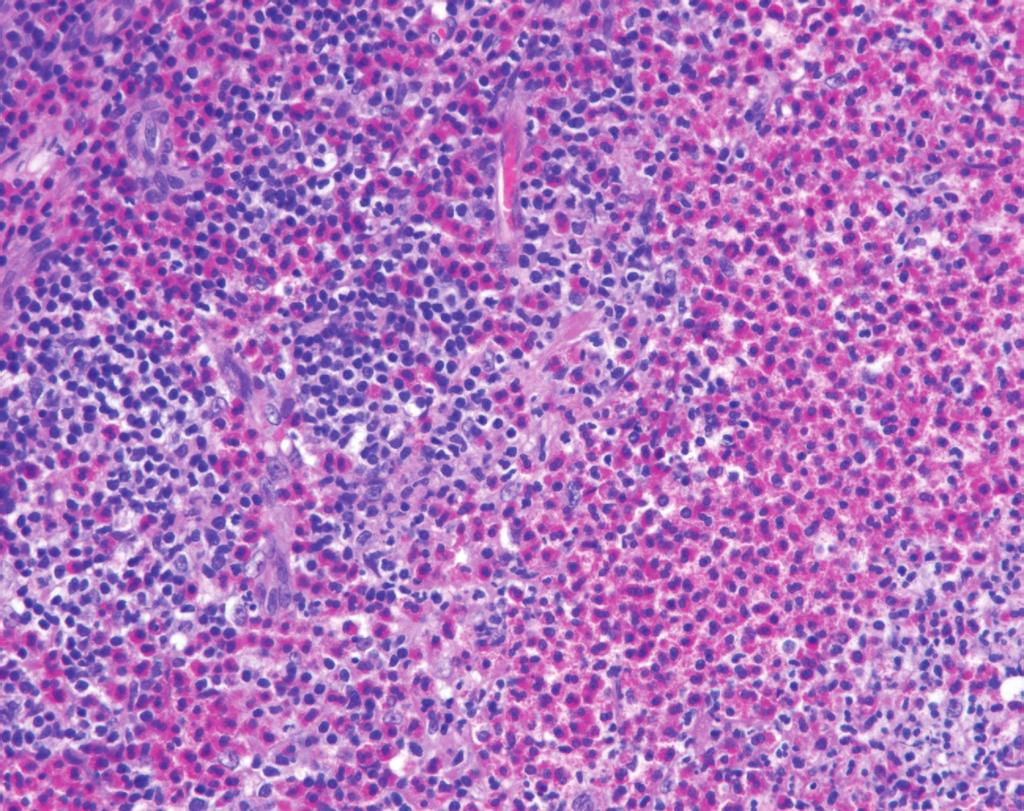 Dense lymphoid and eosinophilic infiltrations in the perinodal soft tissue (SC) crossing the capsule (C) of the lymph node (f, hematoxylin-eosin, 200).