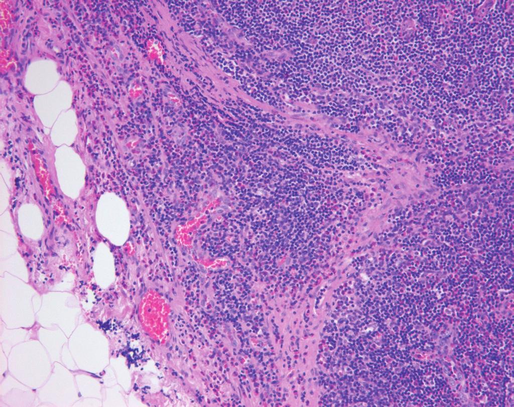 Gross contour of nodal architecture of the largest enlarged lymph node was preserved on gross pathology mapping (Not shown here). of unknown origin and benign clinical course.