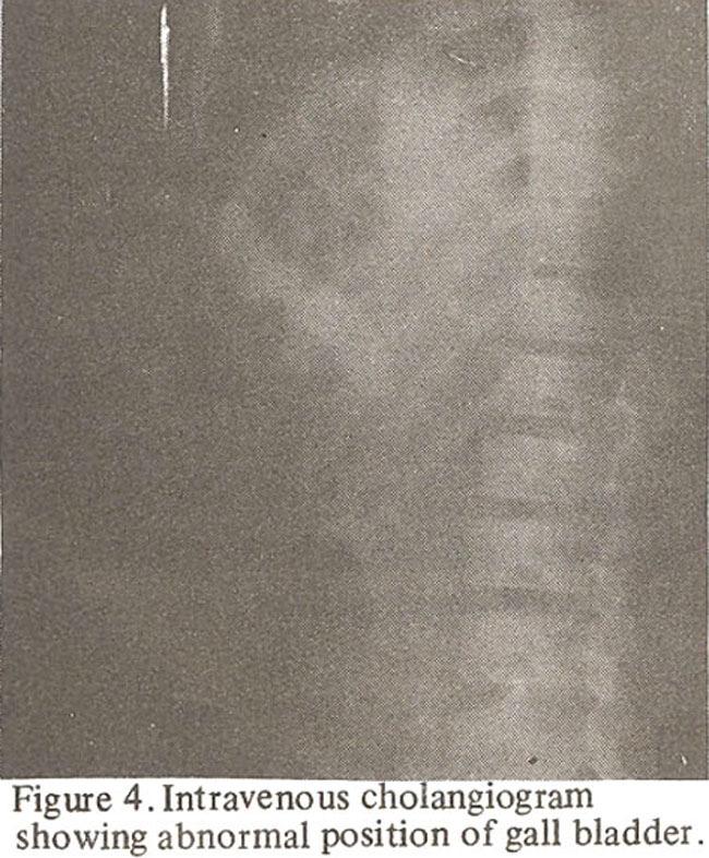 Barium enema examination revealed malpositioning of the transverse colon with its right