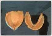 Fig-4: Secondary impression Fig-9: Implant