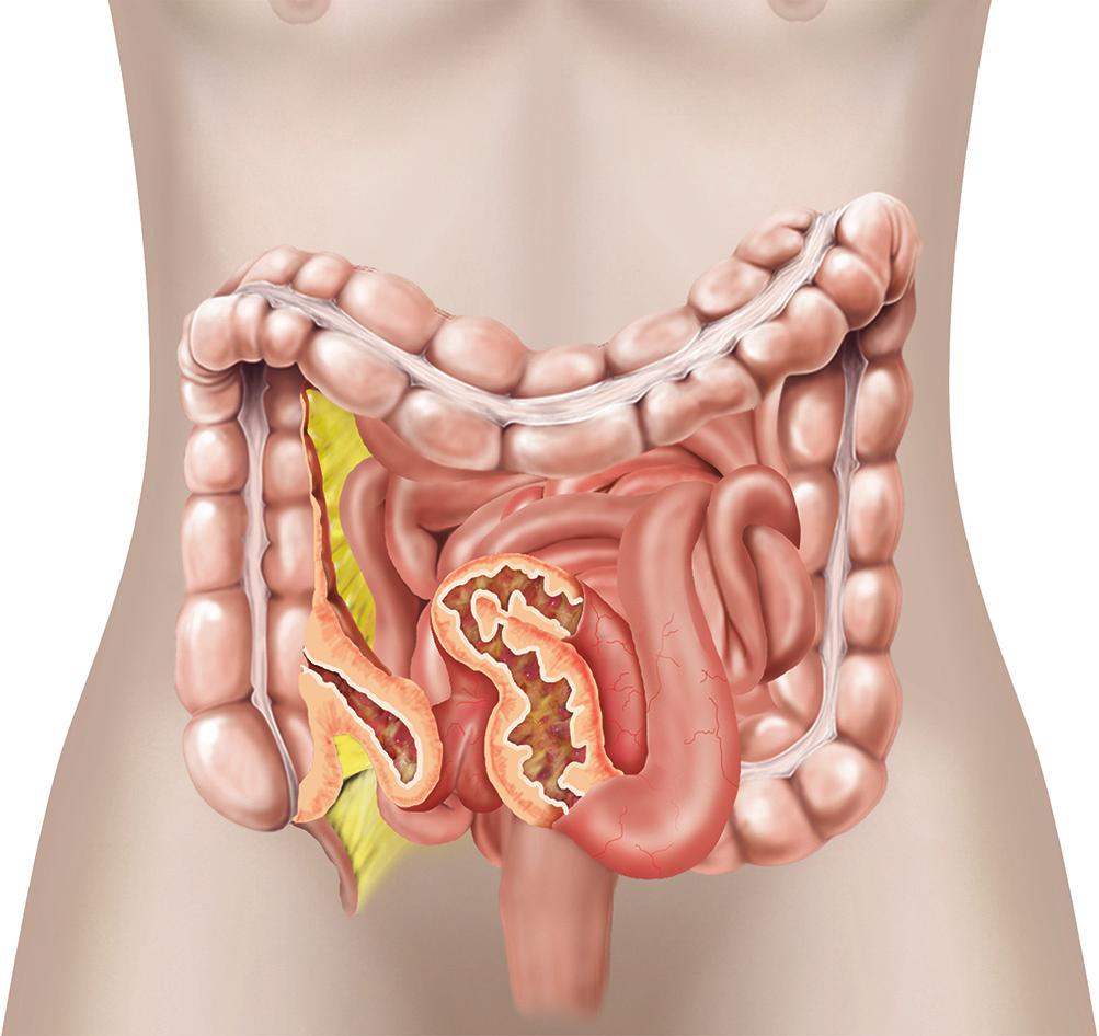 What is Crohns disease? Crohns disease causes inflammation of your intestine. The disease most often affects the end part of your small intestine, called the terminal ileum (see figure 1).