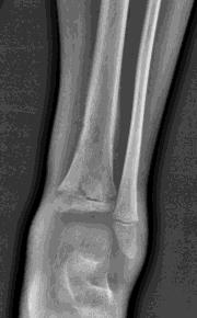 Reactive bone formation 4-year-old boy Axial T2WIs with fat saturation Moth-eaten osteolytic