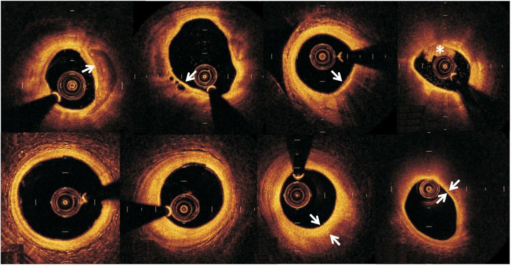OCT Assessment of Plaque Vulnerability Plaque rupture As previously described in the scientific literature, coronary arterial wall often develops significant atherosclerotic changes before the