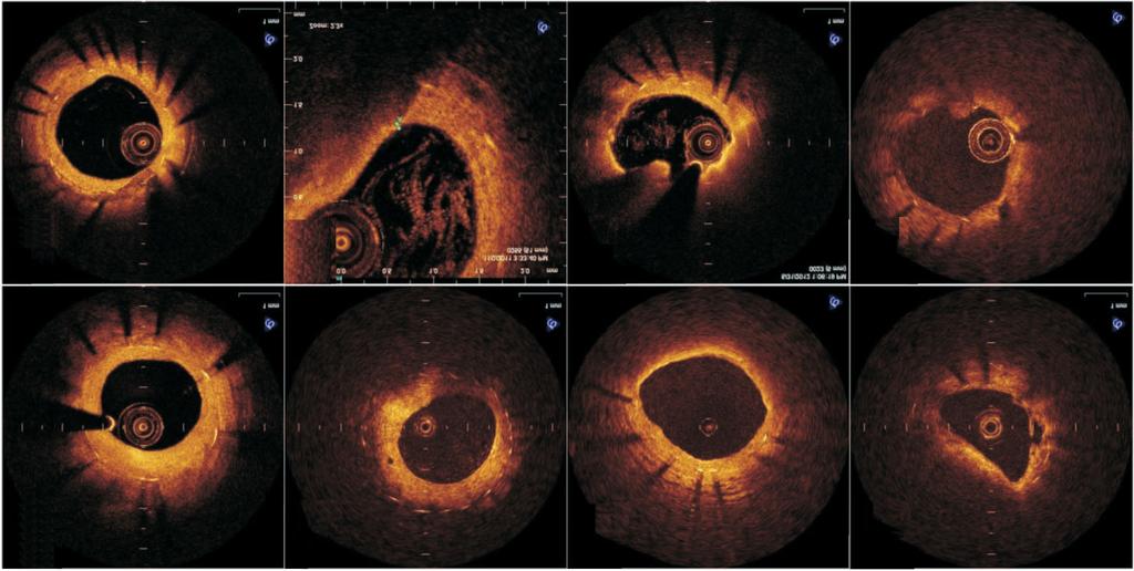 Shiro Uemura et al. A B C D E F G H Figure 4. Development of neoatherosclerotic changes observed within coronary stent. (A) Fibrous neointima. (B) Microchannel. (C) Lipid accumulation.