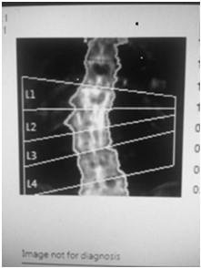 Artifacts on Images Common Degenerative disease Fractures Metal Internal types