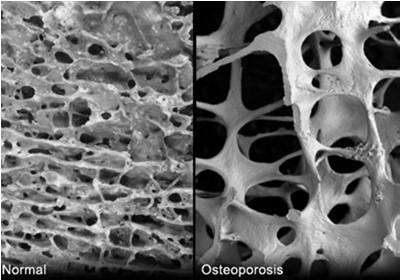 Consequences of Osteoporosis One in two women over the age of 50 will break a bone One in five men over the age of 50 will break a bone *National Osteoporosis Society Who Has Osteoporosis More