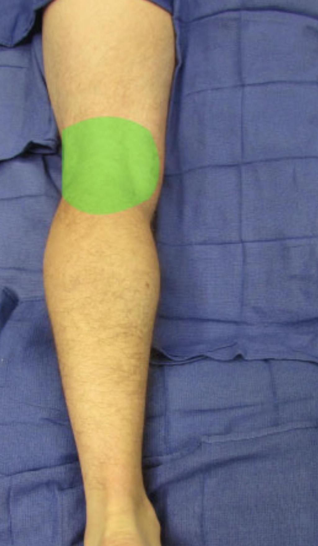 IPACK Injection between the Popliteal artery and the Capsule of