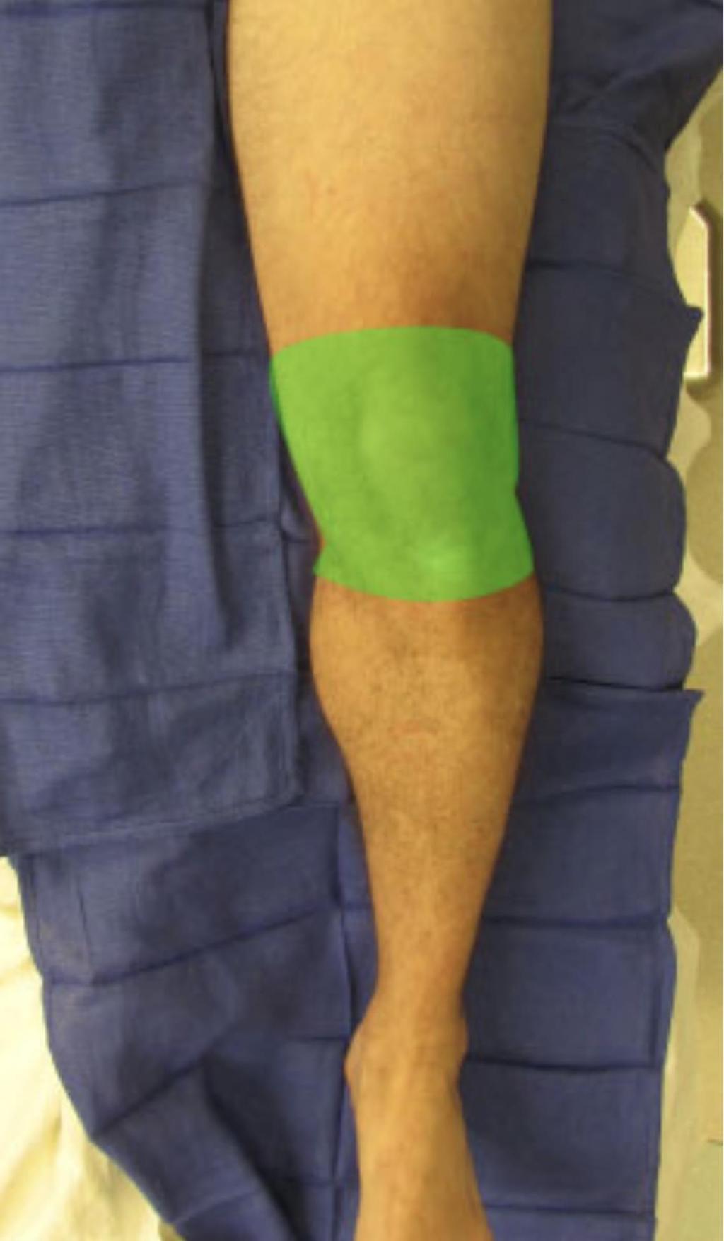 LIA Local Infiltration Analgesia Provides anesthesia to the anterior knee Two needle