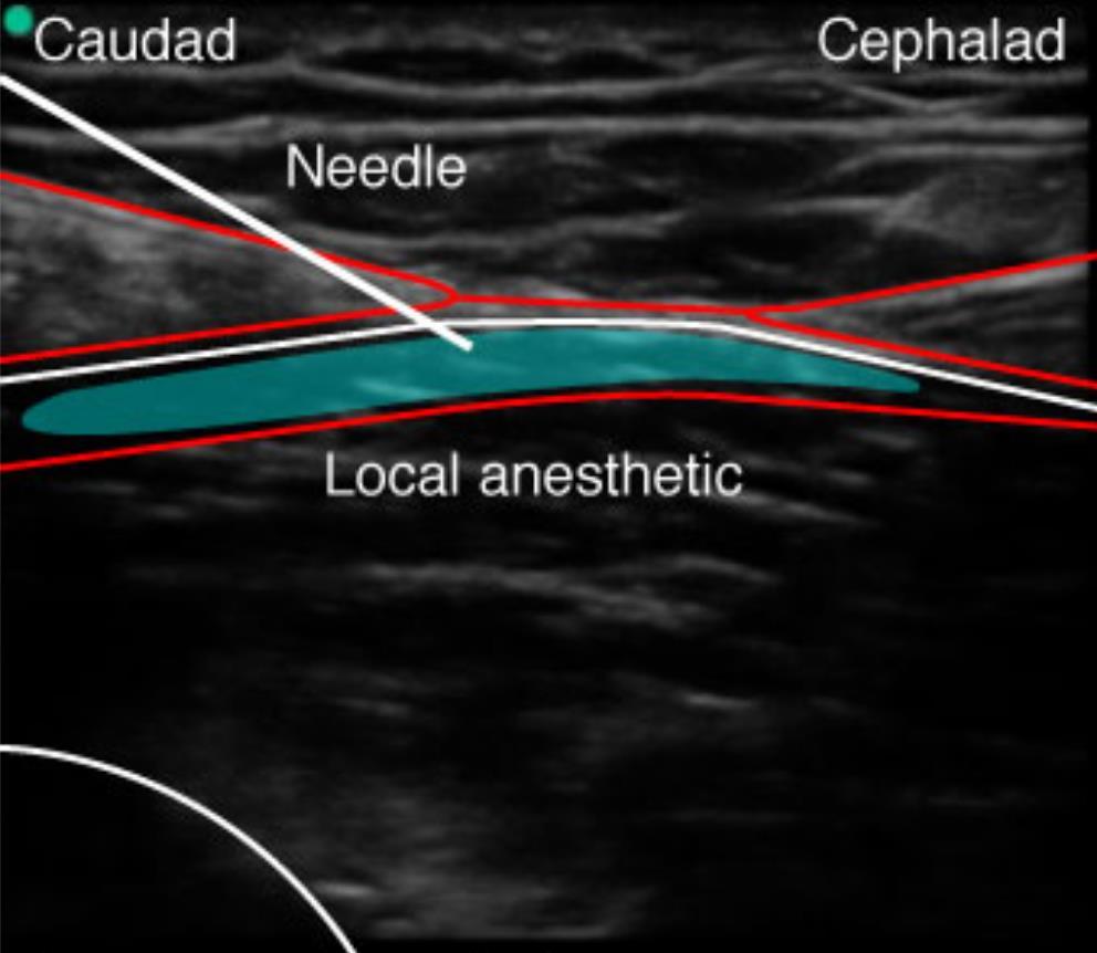 Needle inferior to superior Spread of local anesthetic