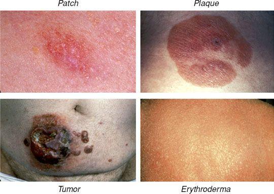 o Diagnosis: the disease is limited to the skin in the vast majority of cases; there is a dermal infiltration of small to