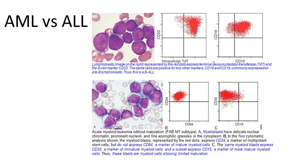 Note in the images the presence of lymphoblasts with scant cytoplasm, oval to round nuclei with fine chromatin (notice how similar they are to mature normal lymphocyte, and hence immunophenotyping is