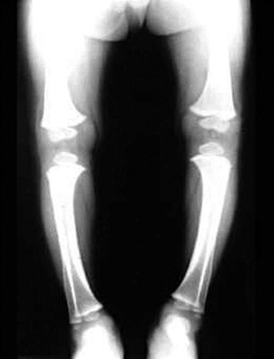 Bone Deformation Rickets can result from insufficient vitamin D in the diet or from insufficient amounts of