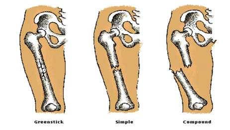 Osteomalacia Failure of adult bone to ossify hip fractures are common most common in elderly Asian Common Fractures greenstick fracture The bone does not break all of the way through.