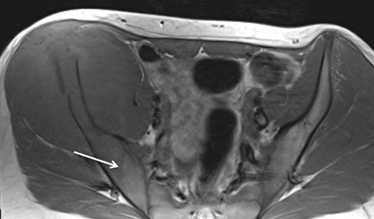 Del Grande et al. Chemical shift imaging 178 A C D B E Figure 2 A 13-year-old male with osteosarcoma of the left iliac bone.