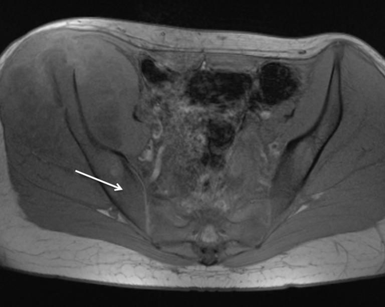 69) show the right iliac osteosarcoma with posterior border (arrow) difficult to differentiate from red marrow; (C) axial OP sequence (TR 130/2.