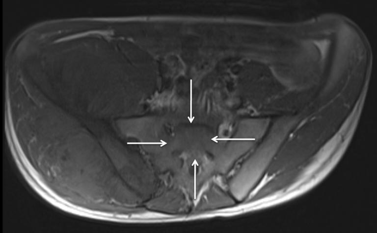 Quantitative Imaging in Medicine and Surgery, Vol 4, No 3 June 2014 179 A B C D E Figure 3 A 20-year-old male with osteosarcoma involving the right iliac and sacral bones.