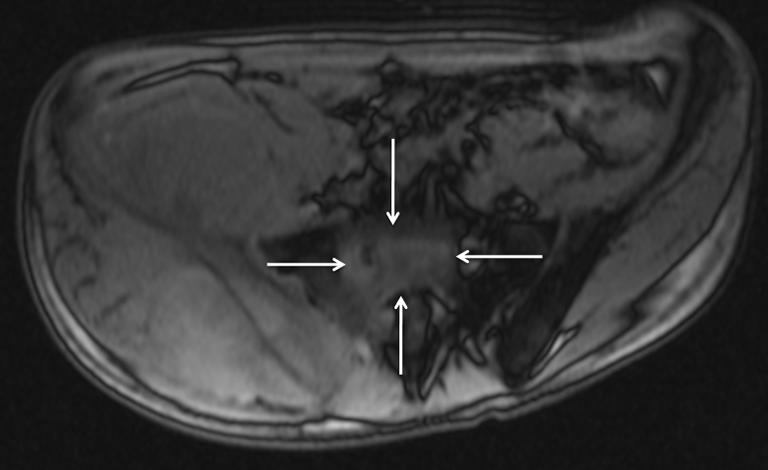 marrow edema; (D) axial contrast-enhanced T1 weighted (gradient echo, TR/TE 10.3/3.