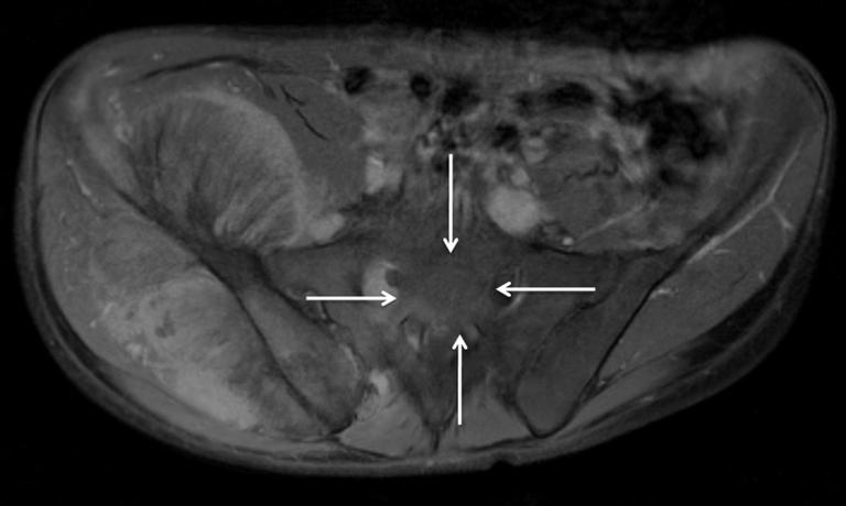 iliac tumor to good advantage but with vague signal abnormality in the sacrum. In this case, surgically-proven sacral involvement (arrows) is clearly visible in the OP images (C).