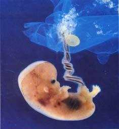 Typical Effects of Radiation on Embryo/Foetus Death of the embryo or fetus Induction of: malformation growth retardation functional disturbance cancer Factors influencing the probability of effects