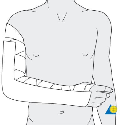 UPPER EXTREMITY Posterior long arm splint Distal humerus fx Elbow