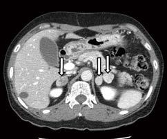 Bilateral cortisol-secreting adenomas Right Left 20 20 A B C Fig. 1. Adrenal computed tomography (CT). Axial images from noncontrast-enhanced adrenal CT show a right adrenal nodule 2.