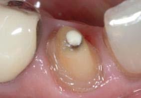 implant placement with