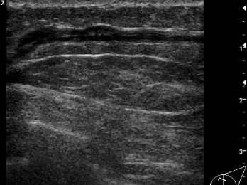 Pathology Sclerosing thrombophlebitis of subcutaneous veins of anterior chest wall