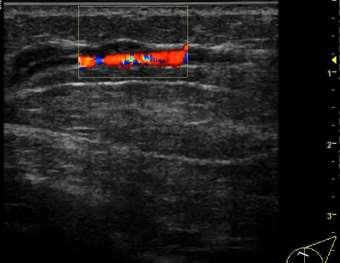 accentuated by raising arm Imaging Findings Superficial tubular beaded vein on imaging