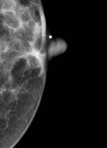 Common asymptomatic breast masses May present as
