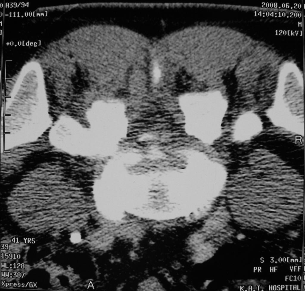 Conclusion CT-guided percutaneous intraspinal needle aspiration is a safe and successful technique for diagnosis and in some cases it may
