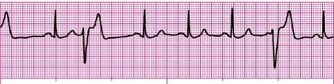 VENTRICULAR RHYTHMS The ventricles are the heart s least efficient pacemaker and only assume the duty if they are not receiving impulses from the other pacemakers, or there is an irritable site