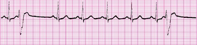 When the impulse begins in the ventricles, the pathways are abnormal resulting in an ECG with absent p-waves and wide QRS complexes.