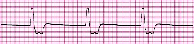 eliminate PVCs, but since ventricular escape beats are the only thing preventing cardiac arrest, treatment is geared to correcting, not eliminating the ventricular escape beats.