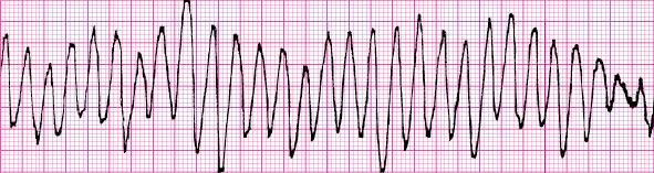 An IVR of 41 to 100 BPM is an accelerated idioventricular rhythm (AIVR). Ventricular Tachycardia exists when three or more PVCs occur in a row at a rate greater than 100 BPM.