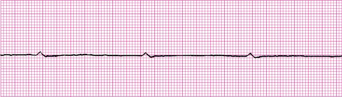 Ventricular Fibrillation is a chaotic rhythm in the ventricles. The ventricles quiver, there is no cardiac output, and no pulse.
