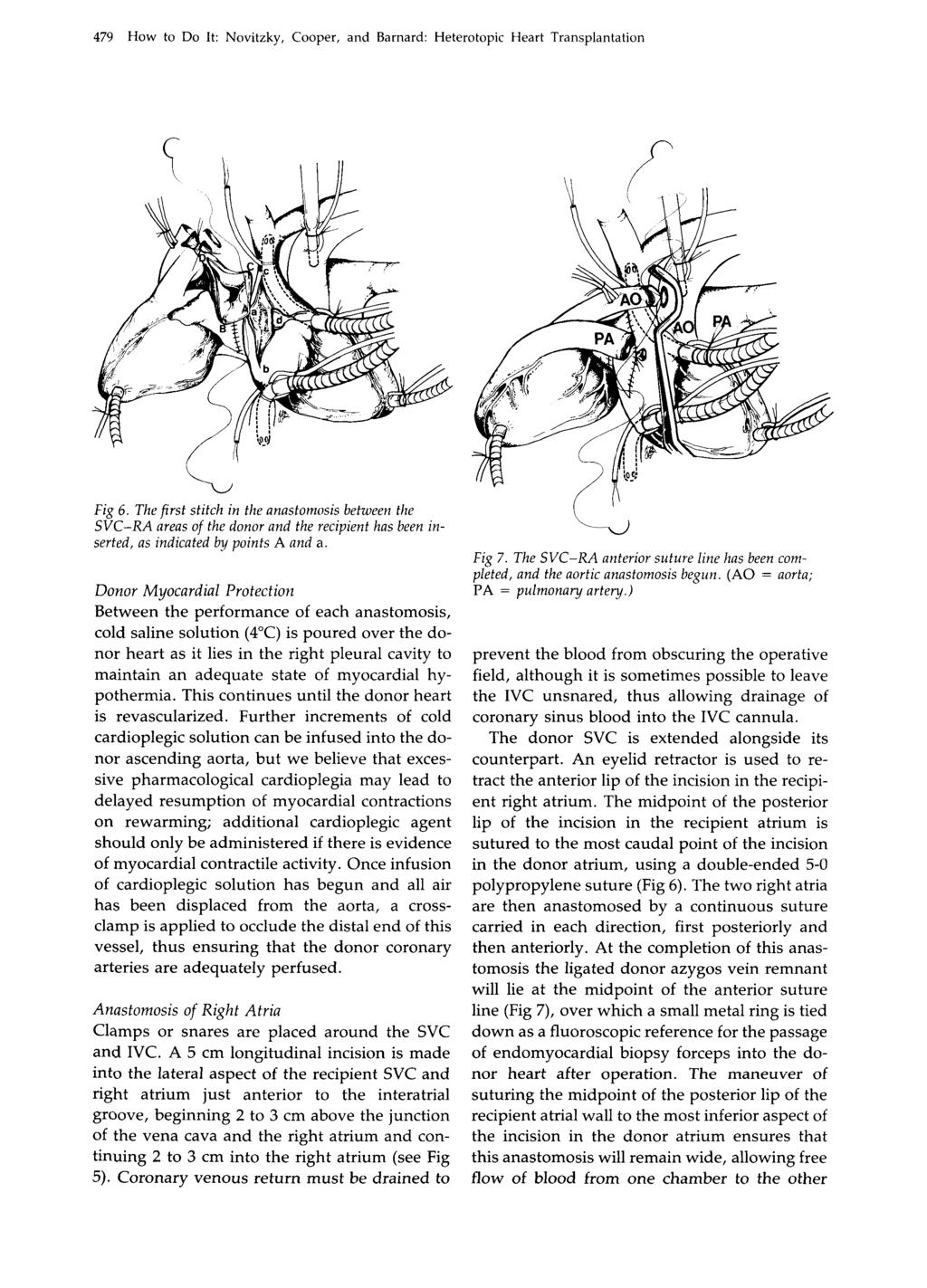 479 How to Do It: Novitzky, Cooper, and Barnard: Heterotopic Heart Transplantation Fig 6.