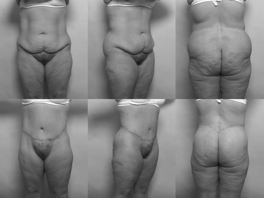 622 A.S. Aly et al / Clin Plastic Surg 31 (2004) 611 624 Fig. 13. This patient s photographs demonstrate an intermediate level of weight loss before surgery.