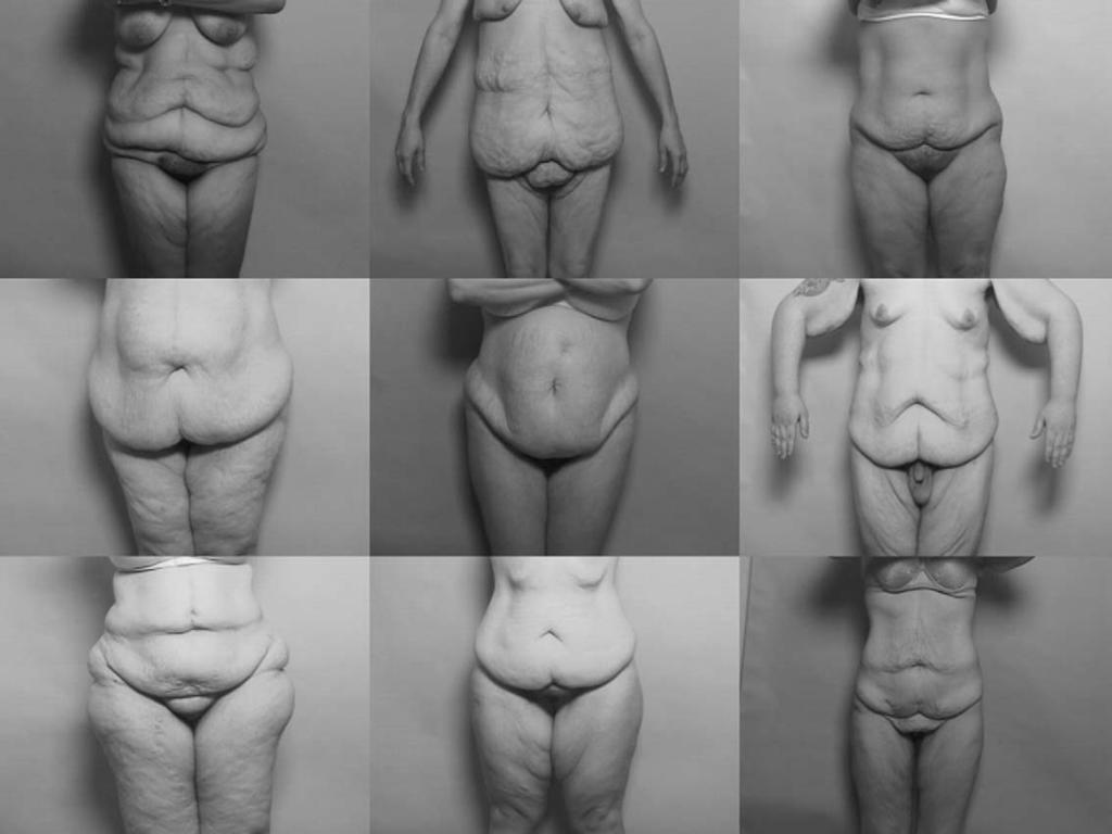 612 A.S. Aly et al / Clin Plastic Surg 31 (2004) 611 624 Fig. 1. A variety of massive weight loss patients on presentation.