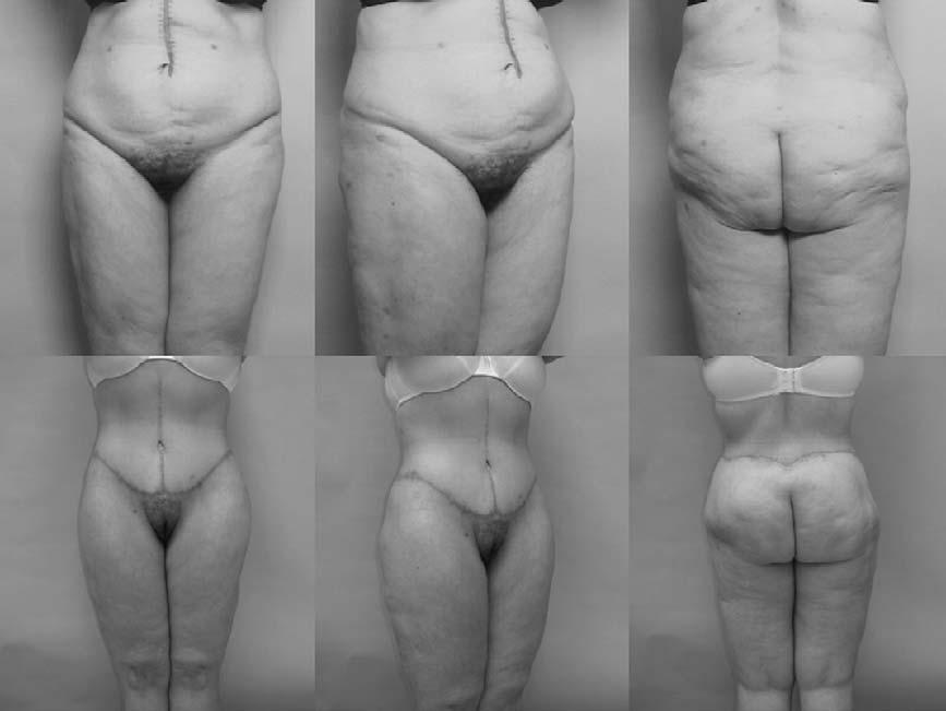 614 A.S. Aly et al / Clin Plastic Surg 31 (2004) 611 624 Fig. 4. Above, this patient demonstrates the lack of definition of the hip and waist region before belt lipectomy surgery.