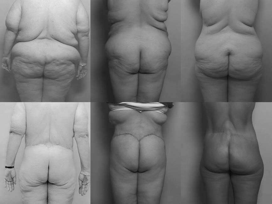 A.S. Aly et al / Clin Plastic Surg 31 (2004) 611 624 615 Fig. 6. Lower back rolls present in various ways (above).
