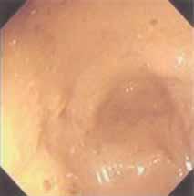 There was an inverted U-shaped loop (the omega sign) of dilated bowel located at the left side of the pelvis ( pelvic overlap sign ).