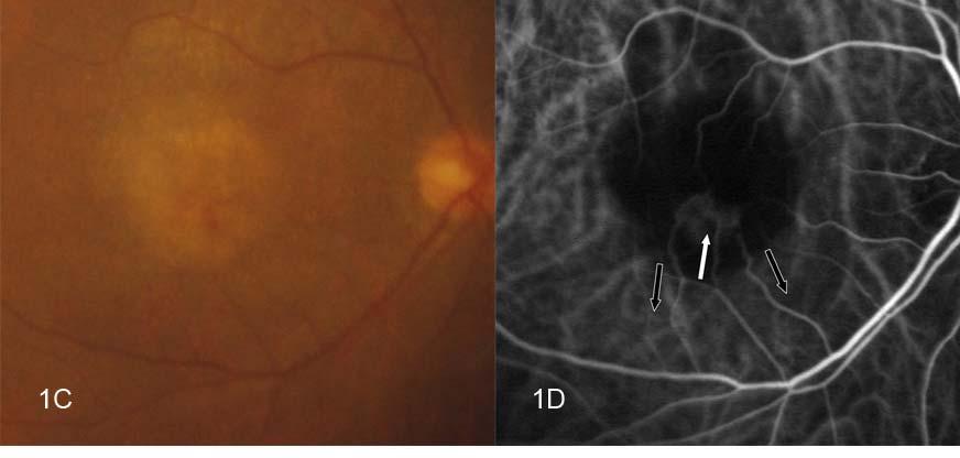 Figure. Case 4. Initial fundus photography and ICG angiography (A, B). There are multiple soft drusens, intraretinal hemorrhage, and serous pigmented epithelium detachment () (A).