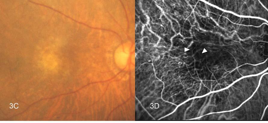Figure 3. Case 7. Initial fundus photography and ICG angiography (3A, B).